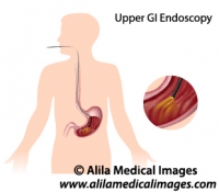 Upper GI endoscopy, medical illustration.