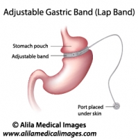 Gastric Band Weight Loss Surgery, labeled diagram.