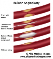Balloon angioplasty procedure diagram