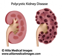 Polycystic kidney disease, medical drawing.