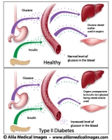 Type 2 diabetes, labeled diagram.