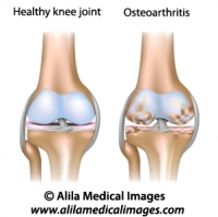 Osteoarthritis of knee joint, medical drawing.