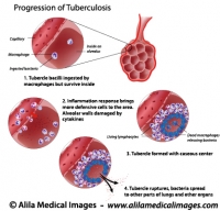 TB bacteria infection, labeled diagram.