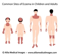 Sites of eczema on body, medical drawing.