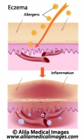 Eczema, allergic reaction, labeled diagram.