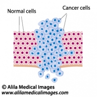 Cancer cells in a growing tumor, labeled diagram.