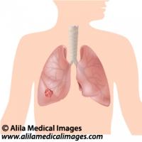 Lung cancer, medical drawing.