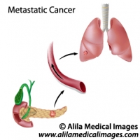 Metastatic cancer diagram