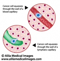 Metastatic cancer, medical drawing.