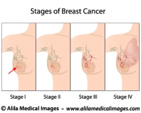 Breast cancer staging, diagram.