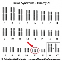 Down syndrome karyotype diagram.