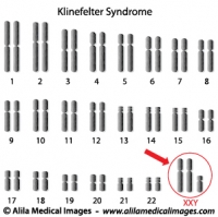 Klinefelter syndrome genome diagram.