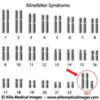 Klinefelter syndrome genome diagram.