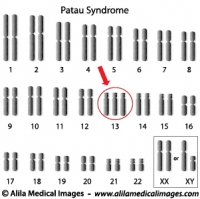 Patau syndrome, trisomy 13 diagram.