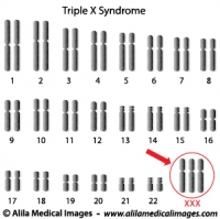 Triple X syndrome genome diagram.