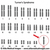 Turner's syndrome genome diagram.