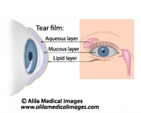 Dry eye syndrome, labeled diagram