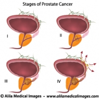 Prostate cancer staging, unlabeled diagram.