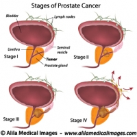 Prostate cancer staging, labeled diagram.