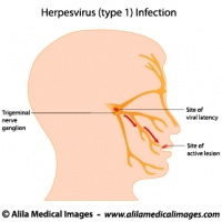 Herpes simplex virus infection, labeled diagram.