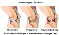 Common types of arthritis, medical drawing.