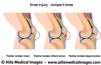 Jumper's knee anatomy, medical illustration.