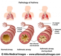 Anatomy of Asthma, labeled. 