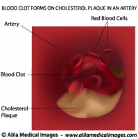 Atherosclerosis, labeled. 