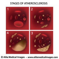 Process of cholesterol plaque in artery, unlabeled