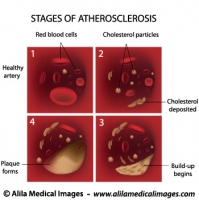 Stages of Atherosclerosis