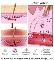 Inflammation process, labeled diagram.