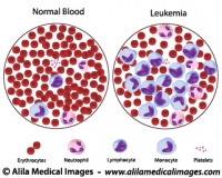 Leukemia versus normal blood count, illustration.