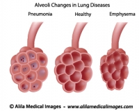 Common respiratory diseases, unlabeled diagram. 