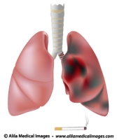 Smoker's lung (with cancer) versus healthy lung
