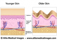 Skin aging, medical illustration.