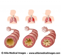 Anatomy of Asthma, labeled. 