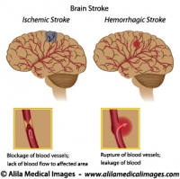 Brain stroke diagrams