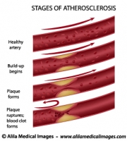 Stages of atherosclerosis diagram