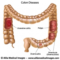 Diseases of the large intestine, labeled diagram.