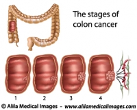 Stages of colon cancer, medical drawing.