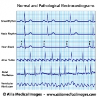Cardiac arrhythmias ECG/ EKG set diagram.