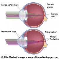 Astigmatism, labeled diagram.