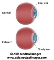 Cataract, labeled diagram.