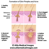 Skin acne formation, labeled diagram.
