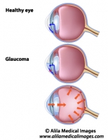 Glaucoma, unlabeled diagram.
