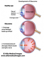 Glaucoma, labeled diagram.