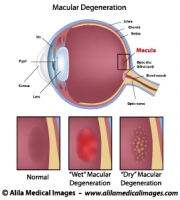 Macular degeneration, labeled diagram.