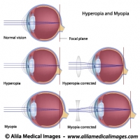 Common eye defects diagrams