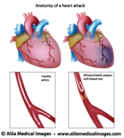 Myocardial infarction diagram (heart attack)